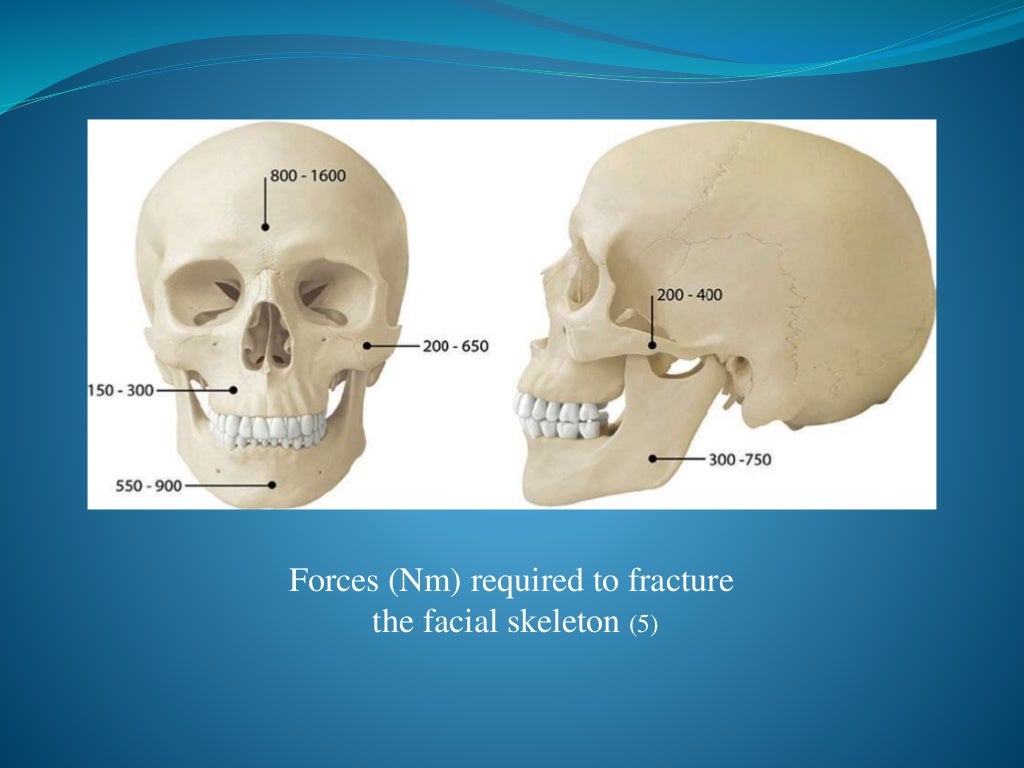 Facial bone fractures an overview