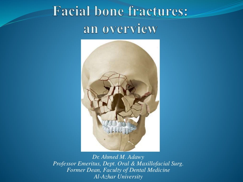 Facial bone fractures an overview