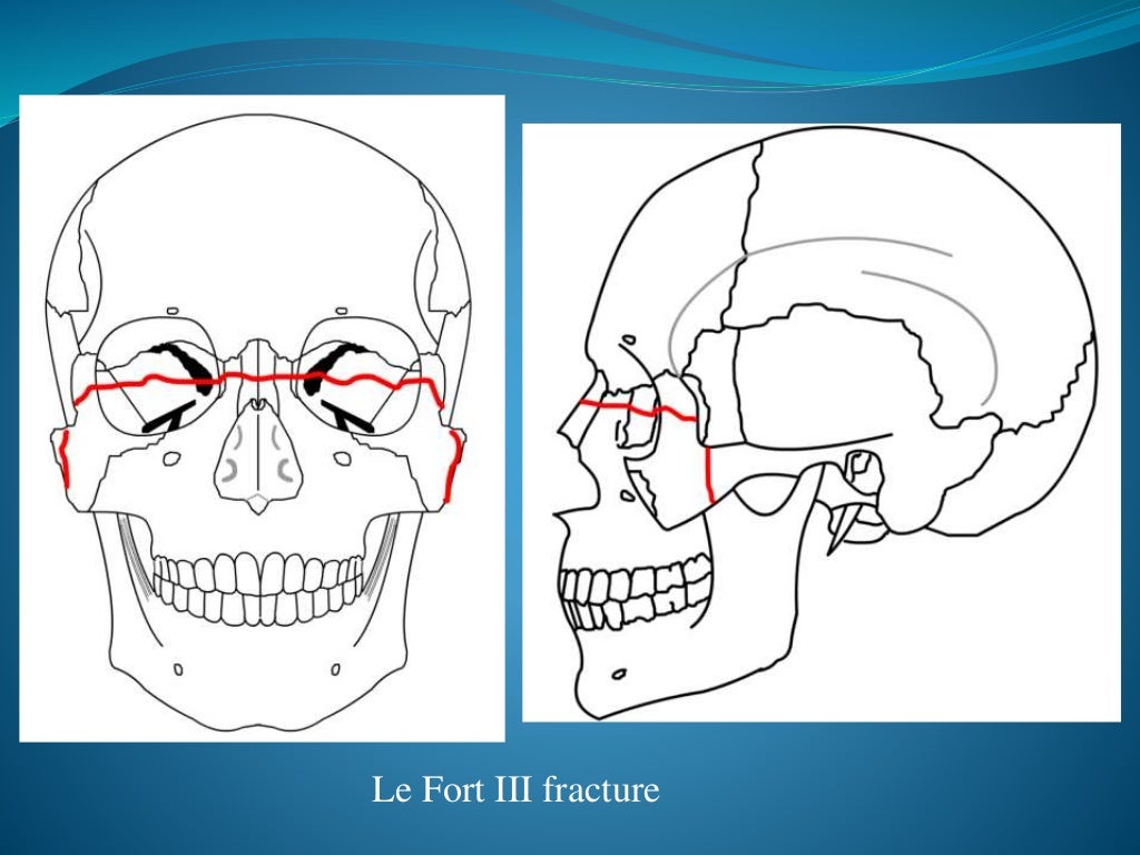 Facial bone fractures an overview
