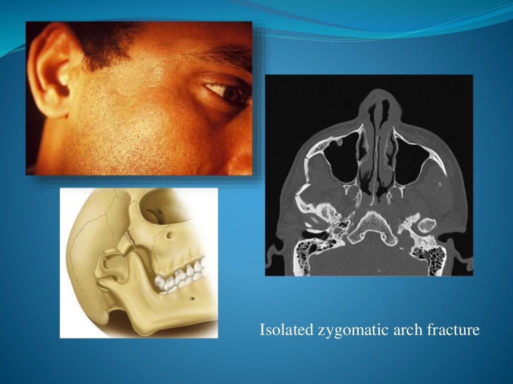 Facial bone fractures an overview