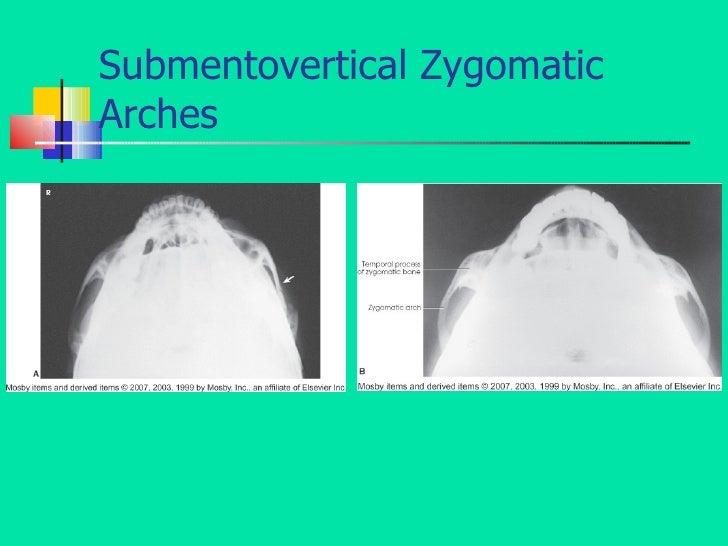 Facial Bones09slideshate