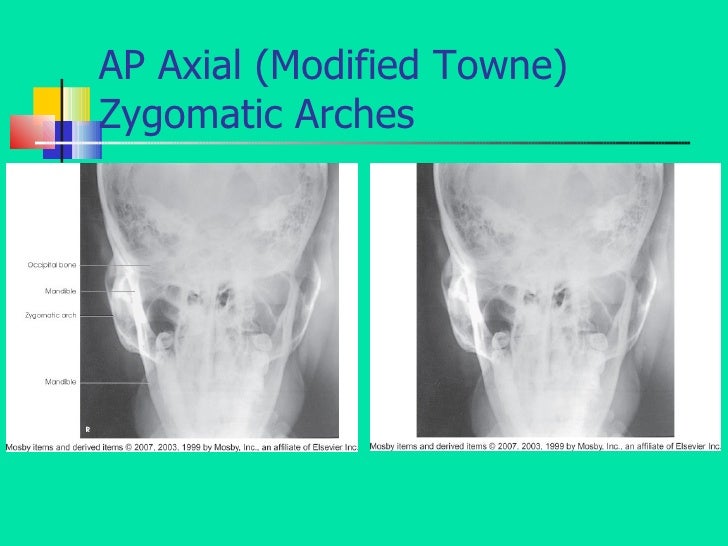 Facial Bones09slideshate