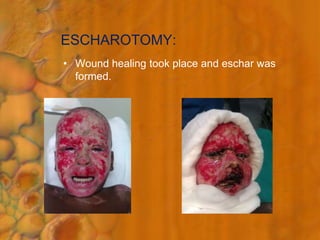 Facial burns in paediatrics | PPTX