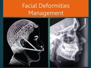 Facial Deformities
Management
 