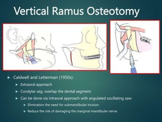 Marginal Ramus Facial Deformities Management: Orthognathic Surgery From Diagnosis to ...