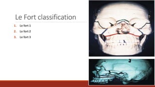 Fort Classification Facial fracture | PPTX