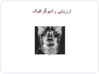 ‫رادیوگرافیک‬ ‫ارزیابی‬
 