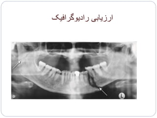 ‫رادیوگرافیک‬ ‫ارزیابی‬
 