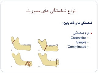 ‫صورت‬ ‫های‬ ‫شکستگی‬ ‫انواع‬
‫پایین‬ ‫فک‬ ‫های‬ ‫شکستگی‬:
‫شکستگی‬ ‫نوع‬
Greenstick
Simple
Comminuted
 