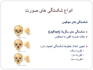 ‫صورت‬ ‫های‬ ‫شکستگی‬ ‫انواع‬
‫میدفیس‬ ‫های‬ ‫شکستگی‬
‫مگزیال‬ ‫های‬ ‫شکستگی‬(LeFort)
‫میدفیس‬ ‫به‬ ‫افقی‬ ‫ضربه‬ ‫بعلت‬
‫دارد‬ ‫اهمیت‬ ‫شکستگی‬ ‫خطوط‬ ‫امتداد‬ ‫تعیین‬
‫یک‬ ‫لفورت‬:
‫دو‬ ‫لفورت‬:
‫سه‬ ‫لفورت‬:
 