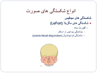 ‫صورت‬ ‫های‬ ‫شکستگی‬ ‫انواع‬
‫میدفیس‬ ‫های‬ ‫شکستگی‬
‫مگزیال‬ ‫های‬ ‫شکستگی‬(LeFort)
‫سه‬ ‫لفورت‬:
‫اسکال‬ ‫از‬ ‫فیس‬ ‫مید‬ ‫جداشدگی‬
‫کرانیوفاسیال‬ ‫شکستگی‬(cranio-facial disjunction)
 