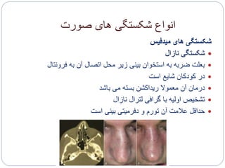 ‫صورت‬ ‫های‬ ‫شکستگی‬ ‫انواع‬
‫میدفیس‬ ‫های‬ ‫شکستگی‬
‫نازال‬ ‫شکستگی‬
‫فرونت‬ ‫به‬ ‫آن‬ ‫اتصال‬ ‫محل‬ ‫زیر‬ ‫بینی‬ ‫استخوان‬ ‫به‬ ‫ضربه‬ ‫بعلت‬‫ال‬
‫است‬ ‫شایع‬ ‫کودکان‬ ‫در‬
‫باشد‬ ‫می‬ ‫بسته‬ ‫ریداکشن‬ ‫معموال‬ ‫آن‬ ‫درمان‬
‫نازال‬ ‫لترال‬ ‫گرافی‬ ‫با‬ ‫اولیه‬ ‫تشخیص‬
‫است‬ ‫بینی‬ ‫دفرمیتی‬ ‫و‬ ‫تورم‬ ‫آن‬ ‫عالمت‬ ‫حداقل‬
 