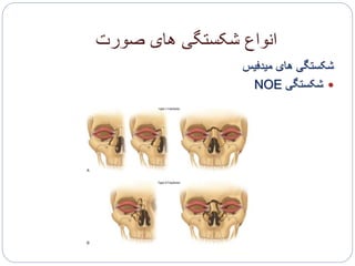 ‫صورت‬ ‫های‬ ‫شکستگی‬ ‫انواع‬
‫میدفیس‬ ‫های‬ ‫شکستگی‬
‫شکستگی‬NOE
 