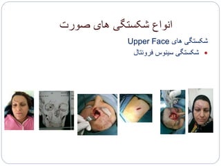 ‫صورت‬ ‫های‬ ‫شکستگی‬ ‫انواع‬
‫های‬ ‫شکستگی‬Upper Face
‫فرونتال‬ ‫سینوس‬ ‫شکستگی‬
 