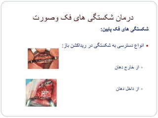 ‫وصورت‬ ‫فک‬ ‫های‬ ‫شکستگی‬ ‫درمان‬
‫پایین‬ ‫فک‬ ‫های‬ ‫شکستگی‬:
‫باز‬ ‫ریداکشن‬ ‫در‬ ‫شکستگی‬ ‫به‬ ‫دسترسی‬ ‫انواع‬:
‫دهان‬ ‫خارج‬ ‫از‬
‫دهان‬ ‫داخل‬ ‫از‬
 