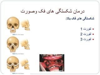 ‫وصورت‬ ‫فک‬ ‫های‬ ‫شکستگی‬ ‫درمان‬
‫باال‬ ‫فک‬ ‫های‬ ‫شکستگی‬:
‫لفورت‬1
‫لفورت‬2
‫لفورت‬3
 