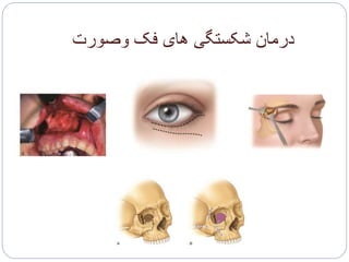 ‫وصورت‬ ‫فک‬ ‫های‬ ‫شکستگی‬ ‫درمان‬
 