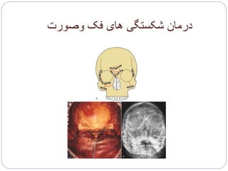 ‫وصورت‬ ‫فک‬ ‫های‬ ‫شکستگی‬ ‫درمان‬
 