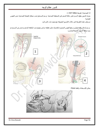 ‫الوجه‬ ‫عظام‬ ‫كسور‬
Dr. firas Kassab Page 96
2-‫حُٜيؿ٤ش‬‫١َ٣وش‬ (Gillies1927):
ٍٞ‫رط‬ ‫حُ٘ن‬ َٟ‫٣ـ‬2ّٞ‫حُو‬ ٠‫كظ‬ ‫حُٜيؿ٤ش‬ ‫حُؼ٠ِش‬ ‫ٛلخم‬ ‫طلض‬ ‫حُظِٔ٤ن‬ ْ‫٣ظ‬ ٝ ‫حُٜيؿ٤ش‬ ‫حُٔ٘طوش‬ ٢‫ك‬ َ‫حُ٘ؼ‬ ‫كخكش‬ ٠ِ‫ػ‬ ْٓ
‫حُؼٌحٍ٣ش‬
‫ػزخص‬ ‫ٝؿٞى‬ ‫ٓغ‬ ‫حُٔؼُِٝش‬ ٌٍُٞٔ‫ح‬ ‫كخ٫ص‬ ٢‫ك‬ ‫حُطَ٣وش‬ ٌٙٛ ‫طٔظطذ‬‫َُِى‬ ٢ُ‫طخ‬
ْ‫ػ‬ ‫حُ٘ٔؾ‬ ٍٝ ّ‫ػي‬ ٝ ْ‫ُِيػ‬ ‫حَُحكؼش‬ ‫طلض‬ ‫طٟٞغ‬ ٕ‫ٗخ‬ ‫هطؼش‬ ٠ِ‫ػ‬ ‫رخ٩ػظٔخى‬ ‫حُٔ٘ـَُس‬ ّٞ‫حُو‬ ‫ٍكغ‬ ٝ ِ٤٤ِ٤‫ؿ‬ ‫ٍحكؼش‬ ٍ‫اىهخ‬ ْ‫٣ظ‬ ٝ
‫حُٔ٘خٓذ‬ ٢٤‫رخُو‬ ‫حُ٘ن‬ ‫ه٤خ١ش‬ ْ‫٣ظ‬
ٌٖٔ٣‫ح٩ٓظؼخٗش‬‫رَحكؼش‬Rowe:
43
2
1
 