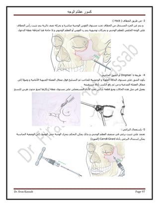 ‫الوجه‬ ‫عظام‬ ‫كسور‬
Dr. firas Kassab Page 97
3-( ‫حُوطخف‬ ‫١َ٣ن‬ ٖ‫ػ‬Hock):
‫حُوطخف‬ ّ‫ٍأ‬ ‫طؼز٤ض‬ ْ‫٣ظ‬ ‫ىحثَ٣ش‬ ‫ٜٗق‬ ‫رلًَش‬ ٝ ‫ٓزخَٗس‬ ‫حُٞؿ٘٤ش‬ ّٞ‫حُو‬ ٟٞ‫ٓٔظ‬ ‫طلض‬ ‫حُوطخف‬ ٖٓ ‫حُٔٔظيم‬ ‫حُـِء‬ َُ‫ؿ‬ ْ‫٣ظ‬ ٝ
ٍٞ‫حُيه‬ ‫ٗوطش‬ ‫ُو٤خ١ش‬ ‫ٛ٘خ‬ ‫كخؿش‬ ٫ ٝ ٢ٜ‫حُٞؿ‬ ْ‫حُؼظ‬ ٝ‫أ‬ ّٞ‫حُو‬ ‫ٍى‬ ْ‫٣ظ‬ ‫طٞؿ٤ٜ٤ش‬ ‫رلًَخص‬ ٝ ٢٘‫حُٞؿ‬ ْ‫ُِؼظ‬ ٢‫حُوِل‬ ٚ‫حُٞؿ‬ ٠ِ‫ػ‬
4-‫١َ٣وش‬Dingman`s: ٢‫حُلخؿز‬ ‫حُ٘ن‬ ٝ‫أ‬
‫حُظِٔ٤ن‬ ْ‫ػ‬ ‫ُِلخؿذ‬ ‫حُٞك٘٤ش‬ ٝ ‫حُؼِٞ٣ش‬ ‫حُلخكش‬ ٟٞ‫ٓٔظ‬ ٠ِ‫ػ‬ ‫حُ٘ن‬ ٌٕٞ٣٠ُ‫ا‬ ٫ٞٛٝ ٝ ‫ح٧ٓخٓ٤ش‬ ‫حُـزٜ٤ش‬ ‫حُؼ٠ِش‬ ‫ٛلخم‬ ‫كٞم‬
‫ٓٔظو٤ٔش‬ ‫رؤىحس‬ ٌَُٔ‫ح‬ ‫ٍكغ‬ ْ‫ػ‬ ٖٓ ٝ ‫حُٜيؿ٤ش‬ ‫حُؼ٠ِش‬ ‫ٛلخم‬
َّٛ ‫كيٝع‬ ‫ُٔ٘غ‬ ‫اٍطٌخُٛخ‬ ‫ٗوطش‬ ٟٞ‫ٓٔظ‬ ٠ِ‫ػ‬ ٠ِٔ‫حُٔٔظؼ‬ ‫ح٧ىحس‬ ‫طلض‬ ٕ‫ٗخ‬ ‫هطؼش‬ ‫ٟٝغ‬ ‫حُلخ٫ص‬ ٌٙٛ َ‫ٓؼ‬ ٢‫ك‬ َ٠‫٣ل‬‫ُِ٘ٔؾ‬
5-: ٢‫حُزَحؿ‬ ٍ‫ربٓظؼٔخ‬
‫حُٔ٘خٓزش‬ ‫حُٟٞؼ٤ش‬ ٠ُ‫ا‬ ٍُٞٛٞ‫ح‬ ٠‫كظ‬ ‫حُٞؿ٘ش‬ ‫رظلَى‬ ٌْ‫حُظل‬ ٌٖٔ٣ ‫رٌُي‬ ٝ ٢٘‫حُٞؿ‬ ْ‫حُؼظ‬ ‫ٓ٘ظٜق‬ ٢‫ك‬ ٢‫رَؿ‬ ‫طؼز٤ض‬ ٠ِ‫ػ‬ ‫طؼظٔي‬
ُ‫ح‬ ٍ‫آظزيح‬ ٌٖٔ٣‫ز‬‫رؤىحس‬ ٢‫َؿ‬Carroll-Girard)‫(حٍُٜٞس‬
 