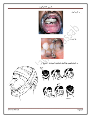 ‫الوجه‬ ‫عظام‬ ‫كسور‬
Dr. firas Kassab Page 29
‫د‬-‫أ‬ ّٞ‫ه‬‫٣َى‬.
‫ؽ‬-: ‫حٍُِ٣ؼخص‬
‫ى‬-ُ‫ح‬‫ـ‬‫حُوزؼ٤ش‬ َ‫زخث‬( ‫حُؤخٗ٤ش‬ ‫ح٧ٍرطش‬ ٝ‫أ‬Barton’s Bandage).
 