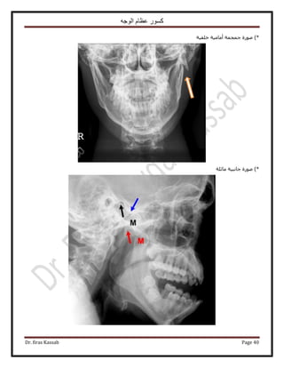 ‫الوجه‬ ‫عظام‬ ‫كسور‬
Dr. firas Kassab Page 40
)*‫هِل٤ش‬ ‫أٓخٓ٤ش‬ ‫ؿٔـٔش‬ ‫ٍٛٞس‬
)*‫ٓخثِش‬ ‫ؿخٗز٤ش‬ ‫ٍٛٞس‬
 