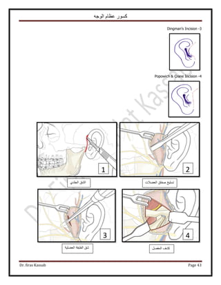 ‫الوجه‬ ‫عظام‬ ‫كسور‬
Dr. firas Kassab Page 43
3-Dingman’s Incision
4-Popowich & Crane Incision
1 2
43
‫الجلدي‬ ‫الشق‬ ‫العضالت‬ ‫صفاق‬ ‫تسلٌخ‬
‫العضلٌة‬ ‫الطبقة‬ ‫شق‬ ‫المفصل‬ ‫كشف‬
 