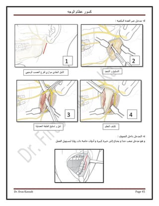 ‫الوجه‬ ‫عظام‬ ‫كسور‬
Dr. firas Kassab Page 45
d-: ‫حٌُ٘ل٤ش‬ ‫حُـيس‬ َ‫ػز‬ َ‫ٓيه‬
e-: ١ٞٔ‫حُل‬ َ‫ىحه‬ َ‫حُٔيه‬
‫ًز٤َس‬ ‫هزَس‬ ٠ُ‫ا‬ ‫٣لظخؽ‬ ٝ ‫ؿيح‬ ‫ٛؼذ‬ َ‫ٓيه‬ ٞٛ َٝٔ‫حُؼ‬ َ٤ٜٔ‫ُظ‬ ‫ُٝح٣خ‬ ‫ًحص‬ ‫هخٛش‬ ‫أىٝحص‬ ٝ
1
3 4
2
‫الشق‬ً‫الوجه‬ ‫العصب‬ ‫لفرع‬ ‫موازي‬ ‫الجلدي‬ ‫التبعٌد‬ ‫و‬ ‫التسلٌخ‬
‫العضلٌة‬ ‫الطبقة‬ ‫تسلٌخ‬ ‫و‬ ‫شق‬ ‫العظم‬ ‫كشف‬
 
