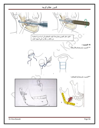 ‫الوجه‬ ‫عظام‬ ‫كسور‬
Dr. firas Kassab Page 46
4-: ‫اىرثثٍد‬
‫ح٧ٓ٬ى‬ ّ‫ربٓظويح‬ ‫حُظؼز٤ض‬ **
: ‫حُٜلخثق‬ ّ‫ربٓظويح‬ ‫**حُظؼز٤ض‬
‫الصفائح‬ ‫تثبٌت‬ ‫خال‬ ‫ٌحتاج‬ ‫الفموي‬ ‫داخل‬ ‫الشق‬‫خاصة‬ ‫مزواة‬ ‫أدواة‬ ‫إلى‬
‫العمل‬ ‫لتسهٌل‬ ً‫براغ‬ ‫مفك‬ ‫و‬ ‫مثاقب‬ ‫من‬
 