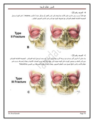 ‫الوجه‬ ‫عظام‬ ‫كسور‬
Dr. firas Kassab Page 76
B-( ْ‫ٍه‬ ‫حُٜ٘ق‬2):
٠ِ‫ػ‬ ٢‫ؿخٗز‬ ٍٝ ‫رٔزذ‬ ً‫خ‬‫ؿخُز‬ ٞٛ‫كَف‬ ٌَ٘‫ر‬ ٝ‫أ‬ ٢‫أكو‬ ًَٔ ٠ُ‫ا‬ ١‫٣ئى‬ ‫ٓٔخ‬ ‫ح٧ٗق‬C(ًَٔJavjavay)َٔ٘٣ ‫حُٞطَس‬ ٢‫ك‬
‫حُٜل٤لش‬٢ٌ‫ُِل‬ ٢ٜ‫حُـز‬ ‫حُ٘خطت‬ ٢‫ك‬ ًَٔ ‫ٓغ‬ ‫حُٞطَس‬ ‫ؿ٠َٝف‬ ‫ٓغ‬ ٢ُ‫حُـَرخ‬ ْ‫ُِؼظ‬ ‫حُوخثٔش‬.
C-( ْ‫ٍه‬ ‫حُٜ٘ق‬3):
ٝ ‫ٗيس‬ َ‫أًؼ‬ َُٝ‫ح‬ ٕ‫أ‬ ٠ِ‫ػ‬ ٍ‫٣ي‬ٝ َ‫أًز‬ ‫َٓػش‬ ًٝ١‫٣ئى‬٢ُ‫حُـَرخ‬ ٚ٤‫حُظ‬ َٔ٘٤ُ ‫٣ٔظي‬ ‫أٗق‬ ًَٔ ٠ُ‫ا‬٢ُ‫ُِـَرخ‬ ‫حُوخثٔش‬ ‫حُٜل٤لش‬ ،
ٝ ‫حُوِق‬ ٠ُ‫ا‬ ٍٝ‫طي‬‫حُلظلخص‬ َُٝ‫ٝر‬ ‫ح٧ٗق‬ ‫ًٍٝس‬ ‫ٍكغ‬ ٠ُ‫ا‬ ‫ٓئى٣ش‬ ٚ‫حُٞؿ‬ َ‫ىحه‬ ‫حُٞطَس‬ ٚٔ‫ط٘و‬.‫ح٧ٗل٤ش‬ٝ‫ٛ٘خى‬‫ا‬٢‫ك‬ ‫ٗي٣ي‬ ‫ٗؤخف‬
ٝ ‫ح٧ٗق‬ ّ‫ػظخ‬ْ‫حُؼظ‬ ‫طلض‬ ‫ُظٜزق‬ 4‫غ‬‫يك‬‫ط‬ ٢‫حُظ‬‫ٝٛ٘خى‬ ،٢ٜ‫حُـز‬‫ا‬ٖ٤٘٤‫حُؼ‬ ٖ٤‫ر‬ ‫ُِٔٔخكش‬ ‫ٝحٟق‬ ‫طٔخع‬Telecanthus
 