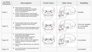 Comprehensive Overview of Facial Fractures: Anatomy, Types, and ...