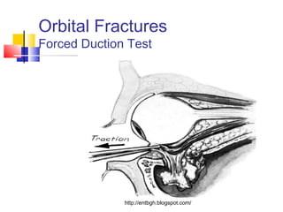 Facial fractures the upper face | PPT