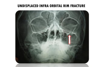 Radiographs in Oral and Maxillofacial Surgery / Facial fractures made ...