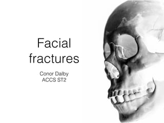 Facial
fractures
Conor Dalby
ACCS ST2
 