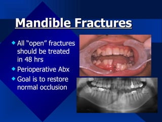 Normal Abx Types of Facial Injuries and Their indications for referrals | PPT