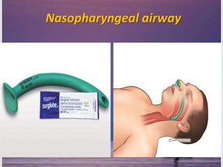 Nasopharyngeal airway
 