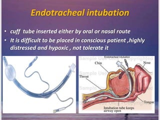 Endotracheal intubation
• cuff tube inserted either by oral or nasal route
• It is difficult to be placed in conscious patient ,highly
distressed and hypoxic , not tolerate it
 