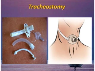 Tracheostomy
 