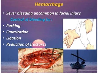 Hemorrhage
• Sever bleeding uncommon In facial injury
Control of bleeding by :
• Packing
• Cautrization
• Ligation
• Reduction of fractures
 