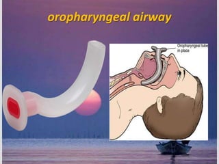 oropharyngeal airway
 