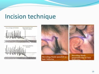 Incision technique
19
 