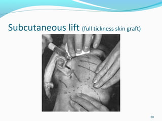 Subcutaneous lift (full tickness skin graft)
20
 