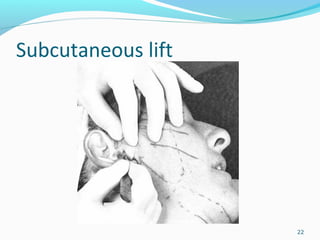 Subcutaneous lift
22
 