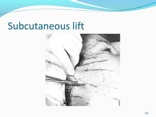Subcutaneous lift
26
 