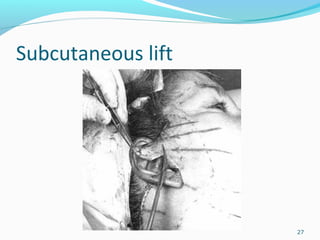 Subcutaneous lift
27
 