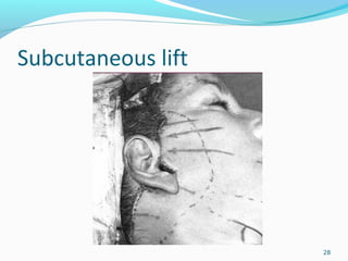 Subcutaneous lift
28
 