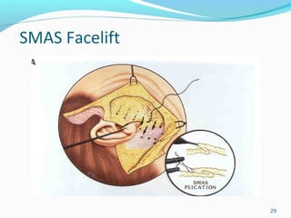 SMAS Facelift
29
 