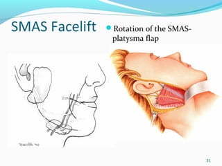 SMAS Facelift Rotation of the SMAS-
platysma flap
31
 
