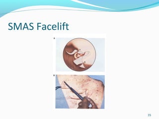 SMAS Facelift
35
 