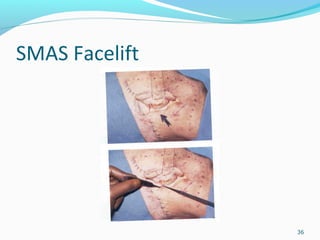 SMAS Facelift
36
 